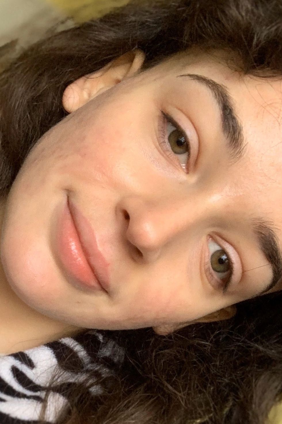accutane before after