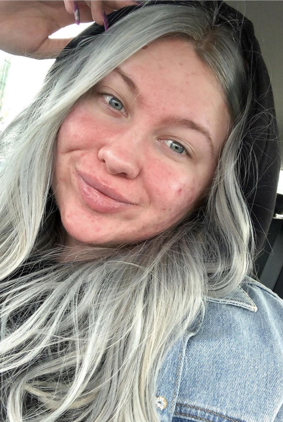 accutane before after