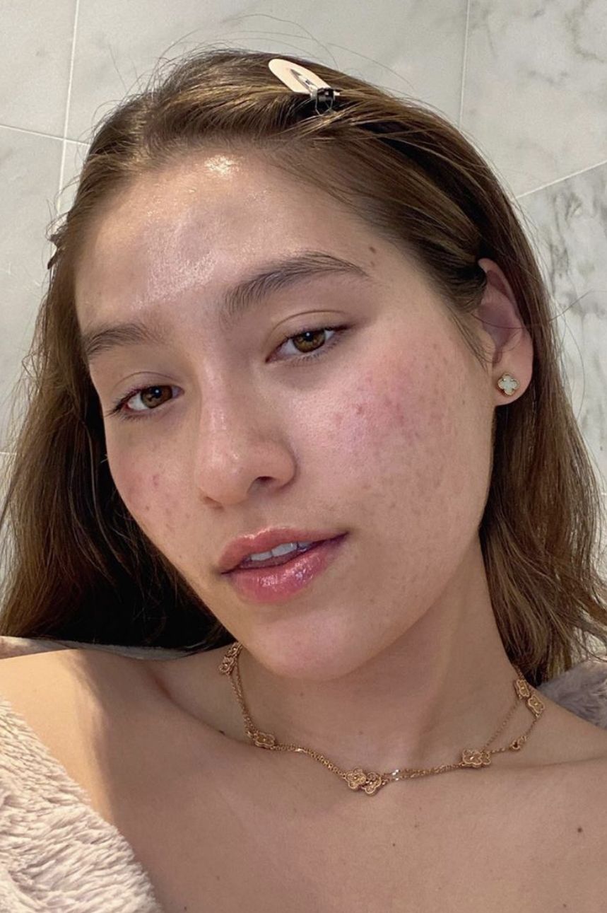 accutane before after