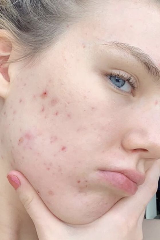 accutane before after