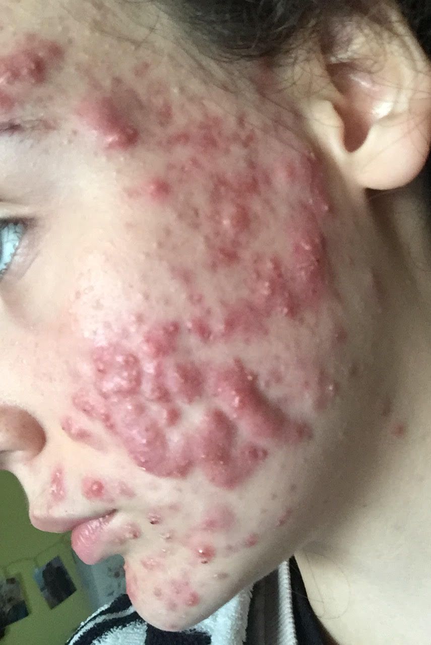 accutane before after