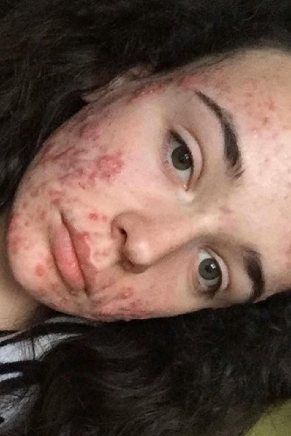 accutane before after