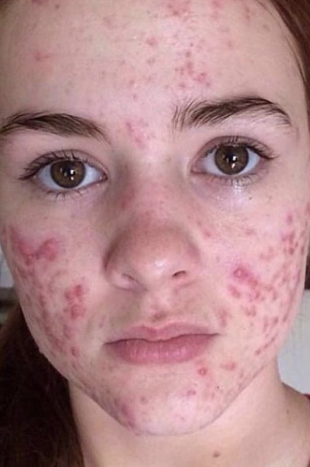 accutane before after